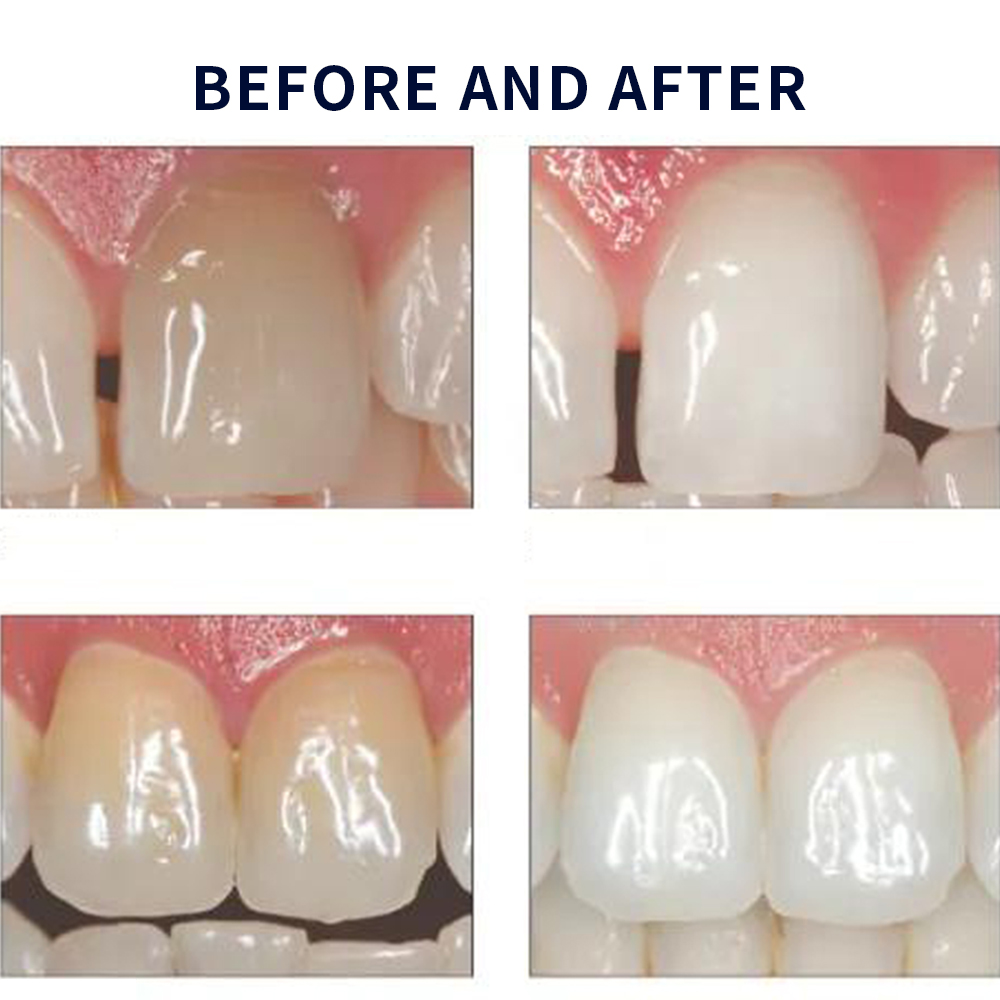Opalescence Whitening 20% PF 2 - Teeth Whitening Shade Guide 评论和价格