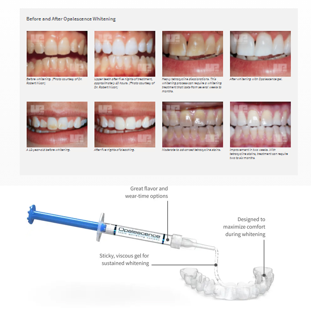 Opalescence Whitening 20% PF 2 - Teeth Whitening Shade Guide 评论和价格