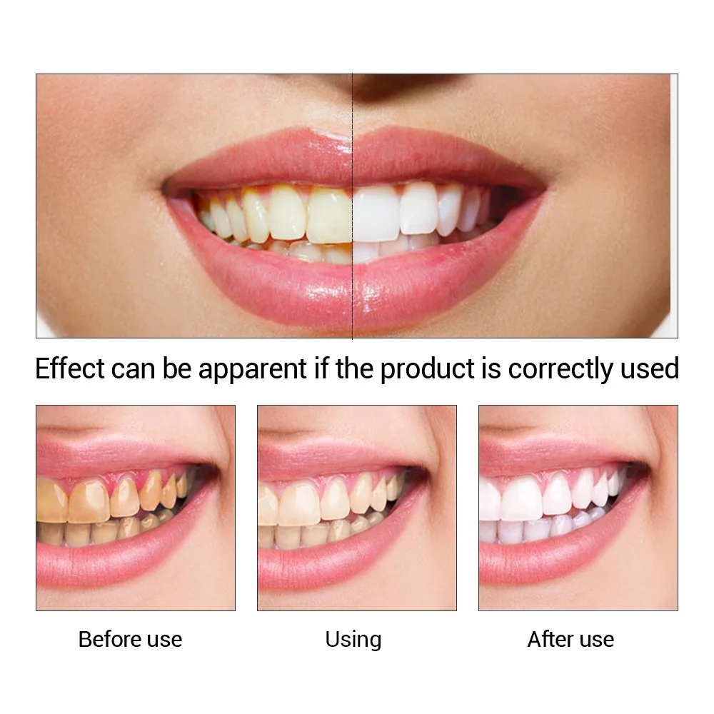 FTEENPLY Teeth Whitening Essen - Teeth Whitening Ingredients 评论和价格