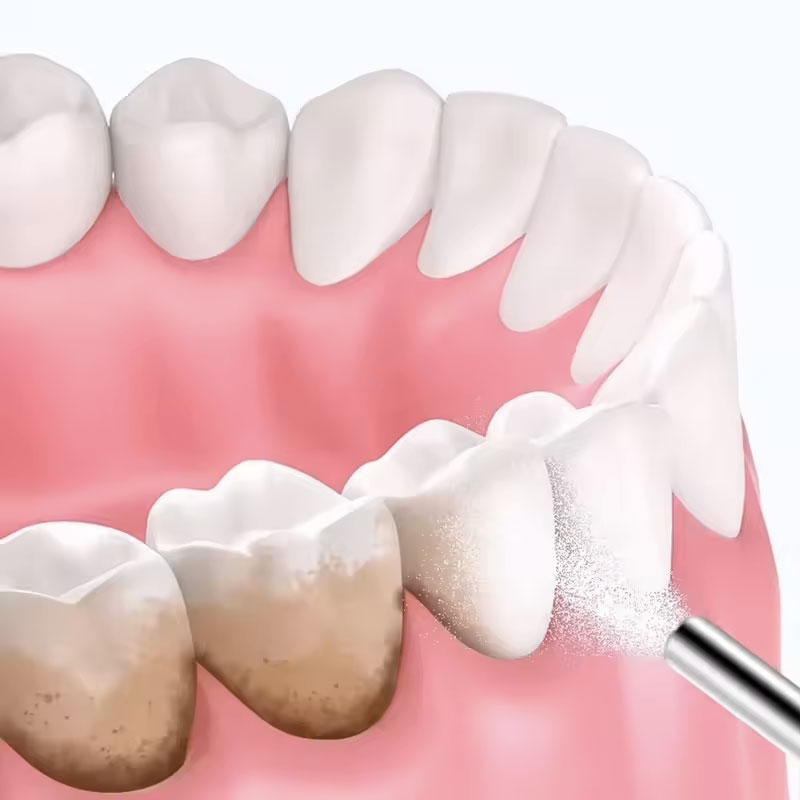 130g Dental Sandblasting Powde - Teeth Whitening Ingredients 评论和价格