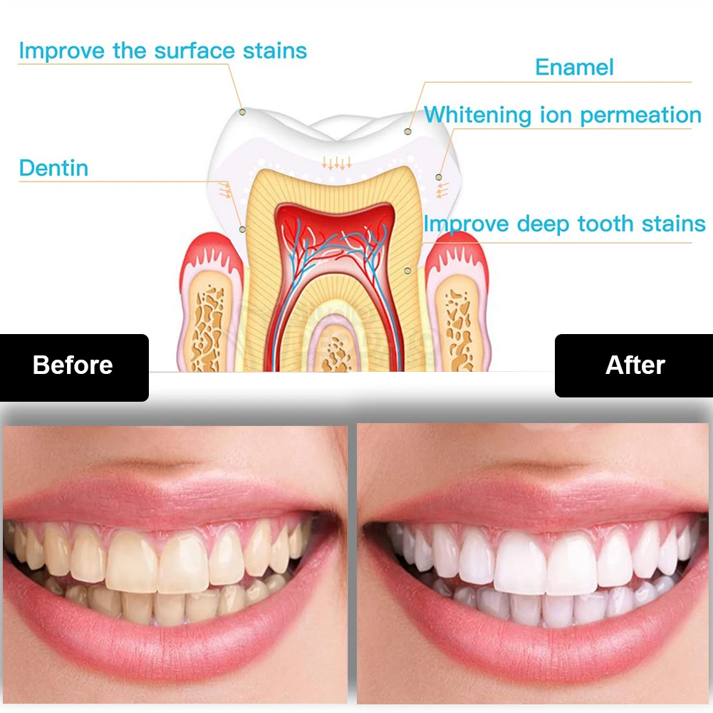 Dental Teeth Whitening Kit Min - Teeth Whitening Tray 评论和价格